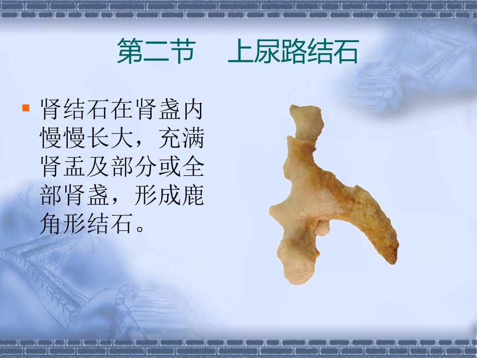 泌尿科-尿石症_第13页
