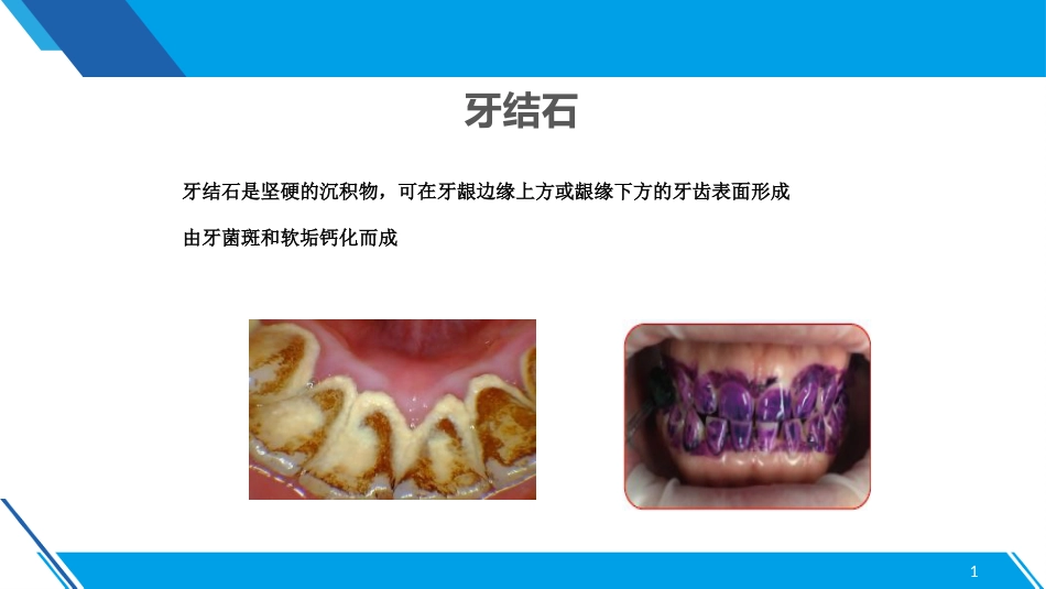 洁牙2_第14页