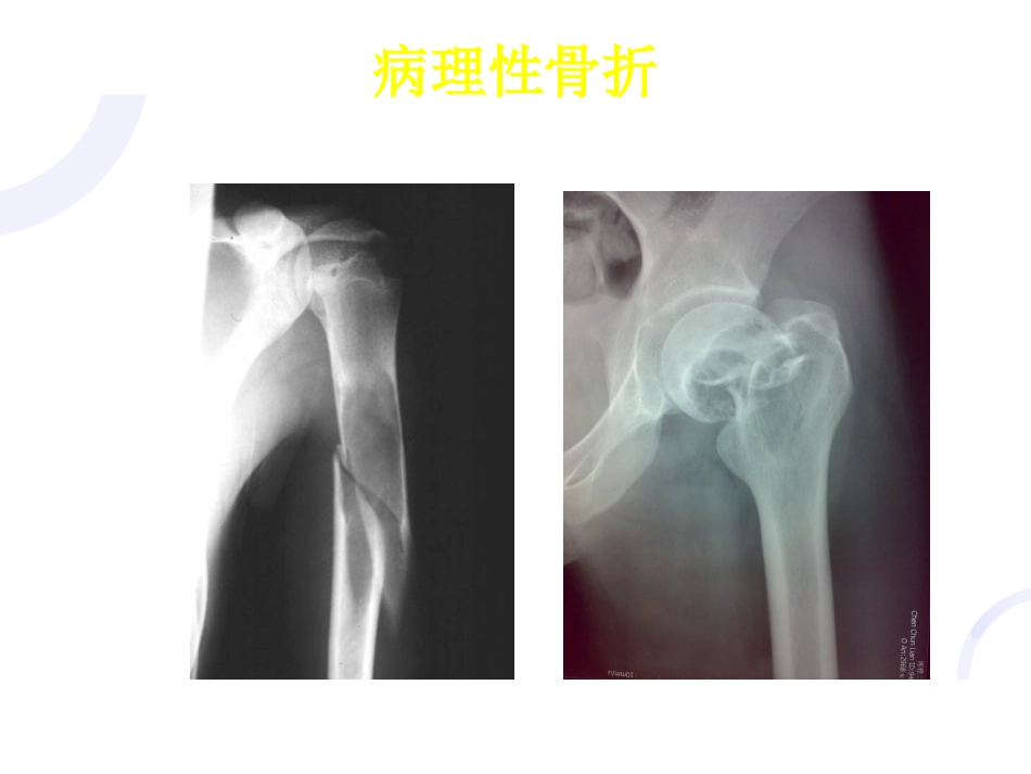 骨科-骨折概论（修改）_第9页