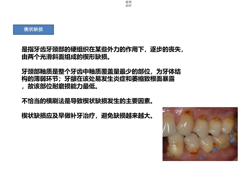 4-龋齿_第9页