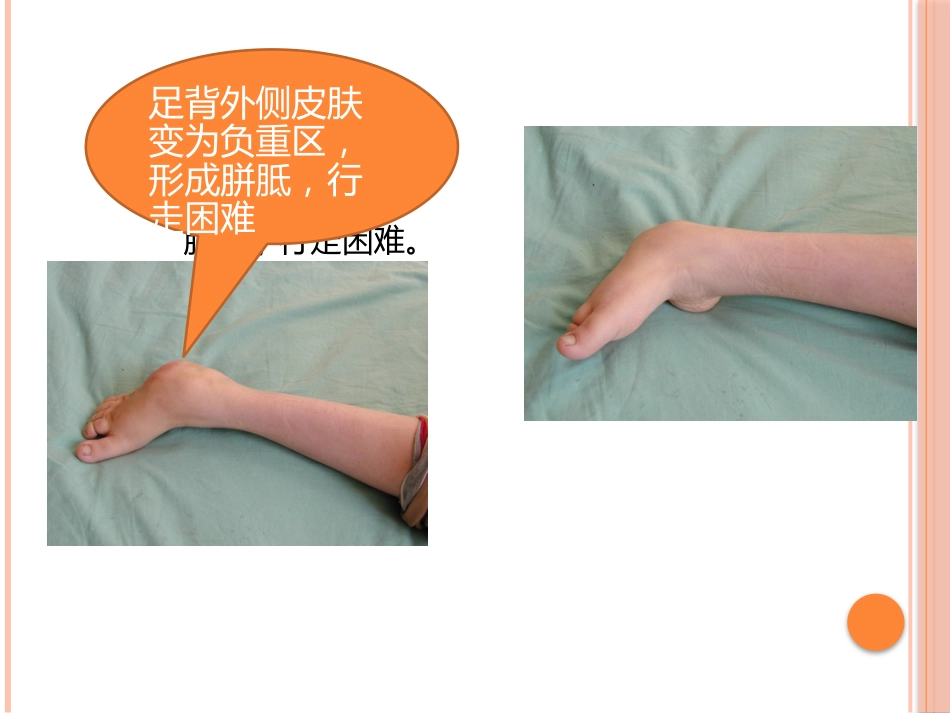 先天性马蹄内翻足的早期治疗_第10页