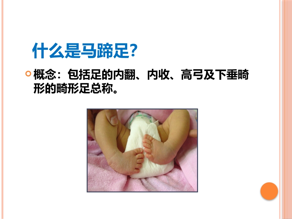先天性马蹄内翻足的早期治疗_第6页