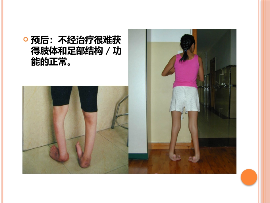 先天性马蹄内翻足的早期治疗_第9页