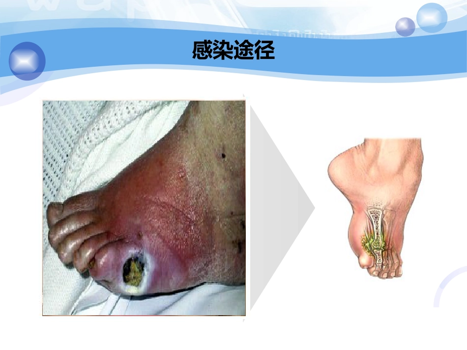 骨科-骨与关节化脓性感染、结核_第6页