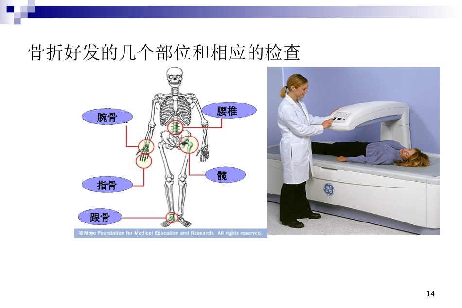 骨科-骨质疏松症ppt_第14页