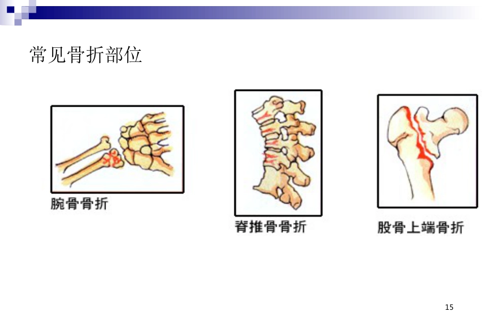 骨科-骨质疏松症ppt_第15页