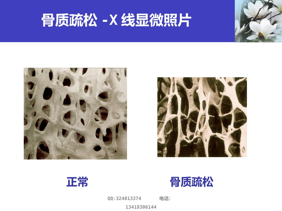 骨质疏松科普知识_第11页