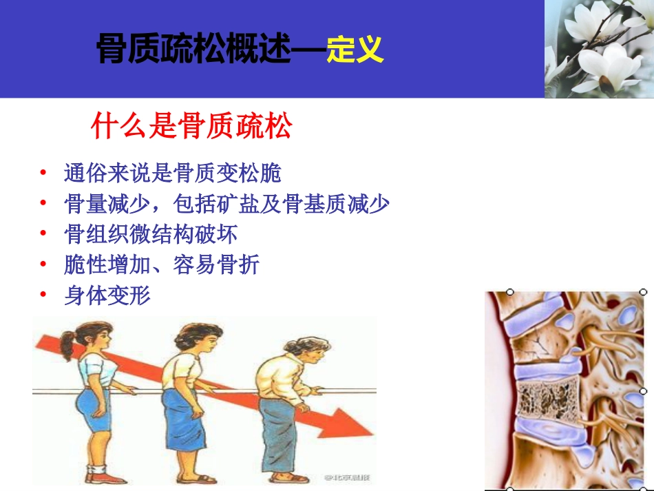 骨质疏松科普知识_第9页