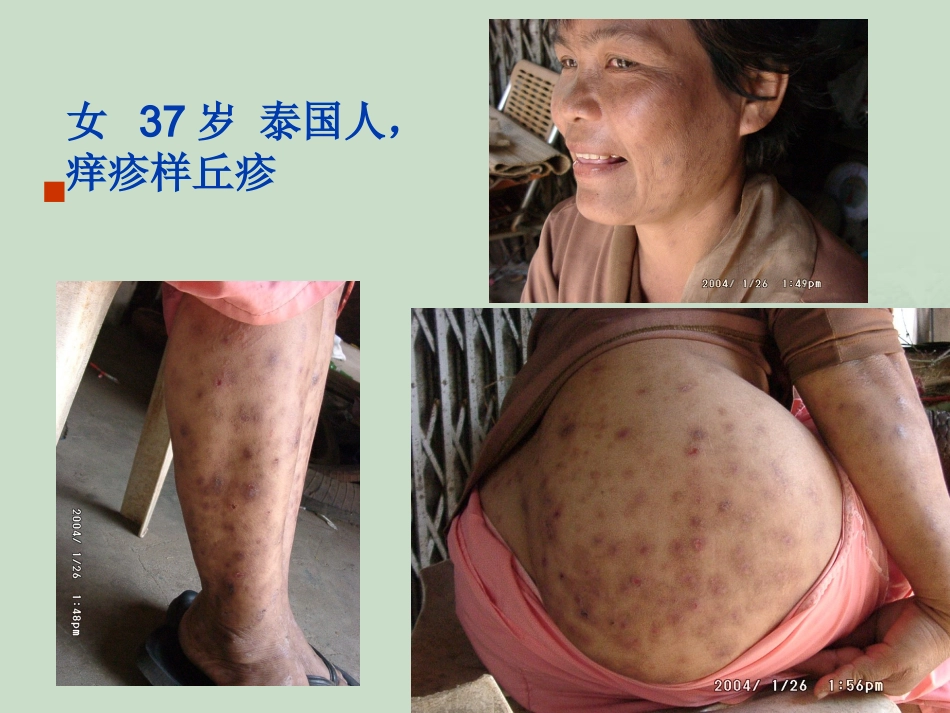 艾滋病_第10页