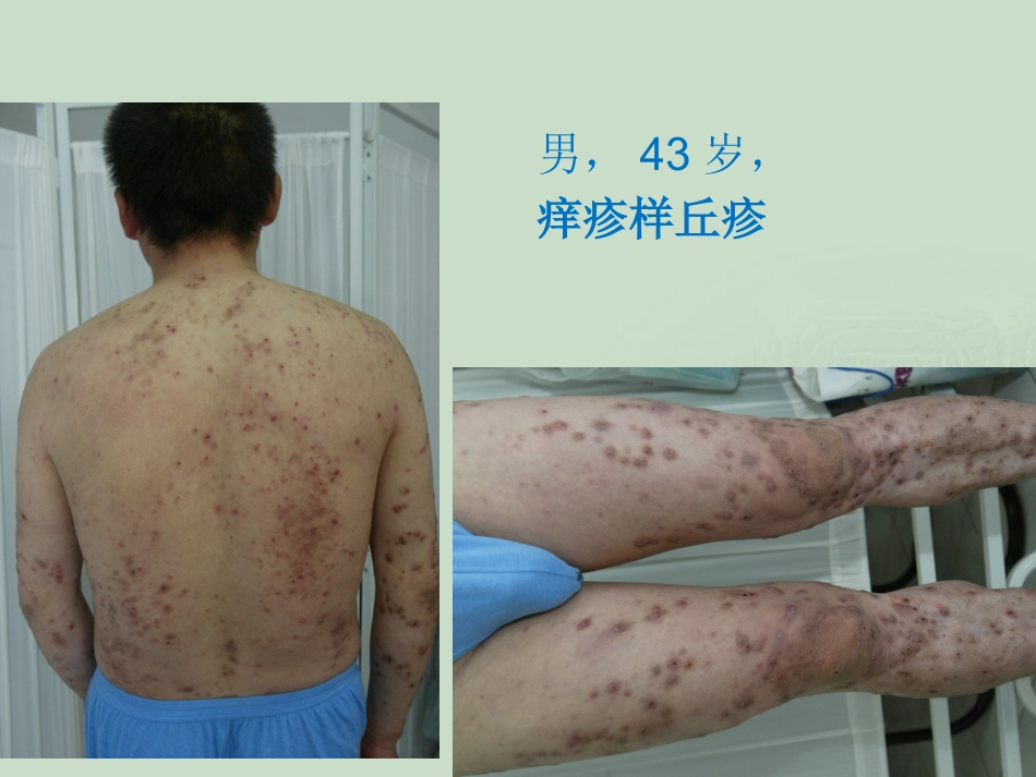 艾滋病_第12页