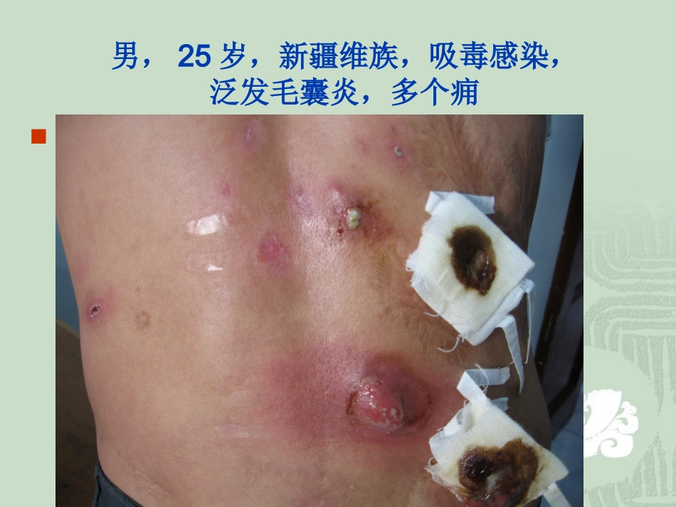 艾滋病_第13页