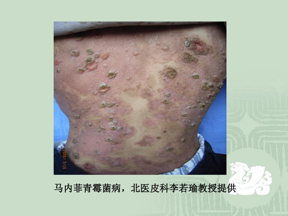 艾滋病_第14页