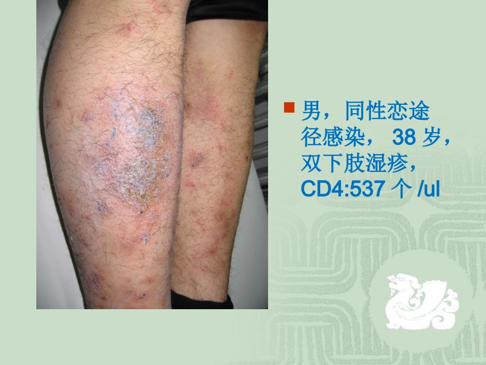 艾滋病_第2页