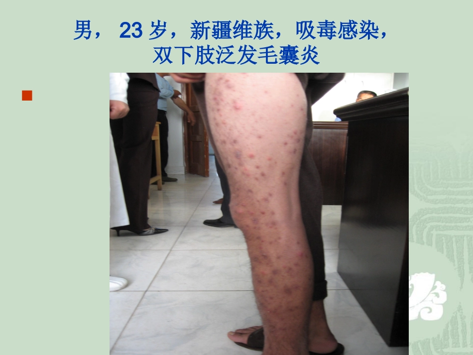 艾滋病_第3页