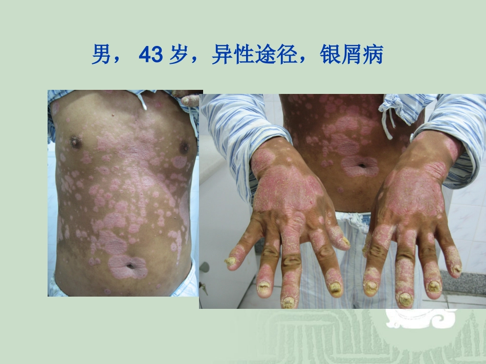 艾滋病_第4页