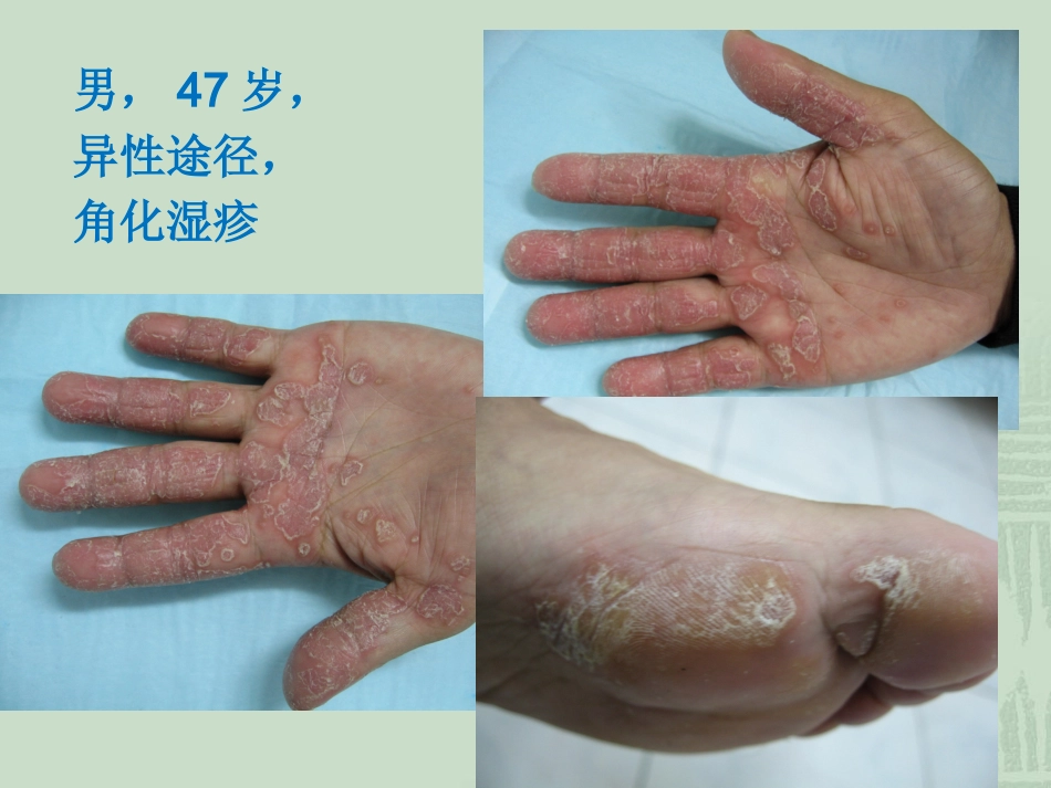 艾滋病_第5页