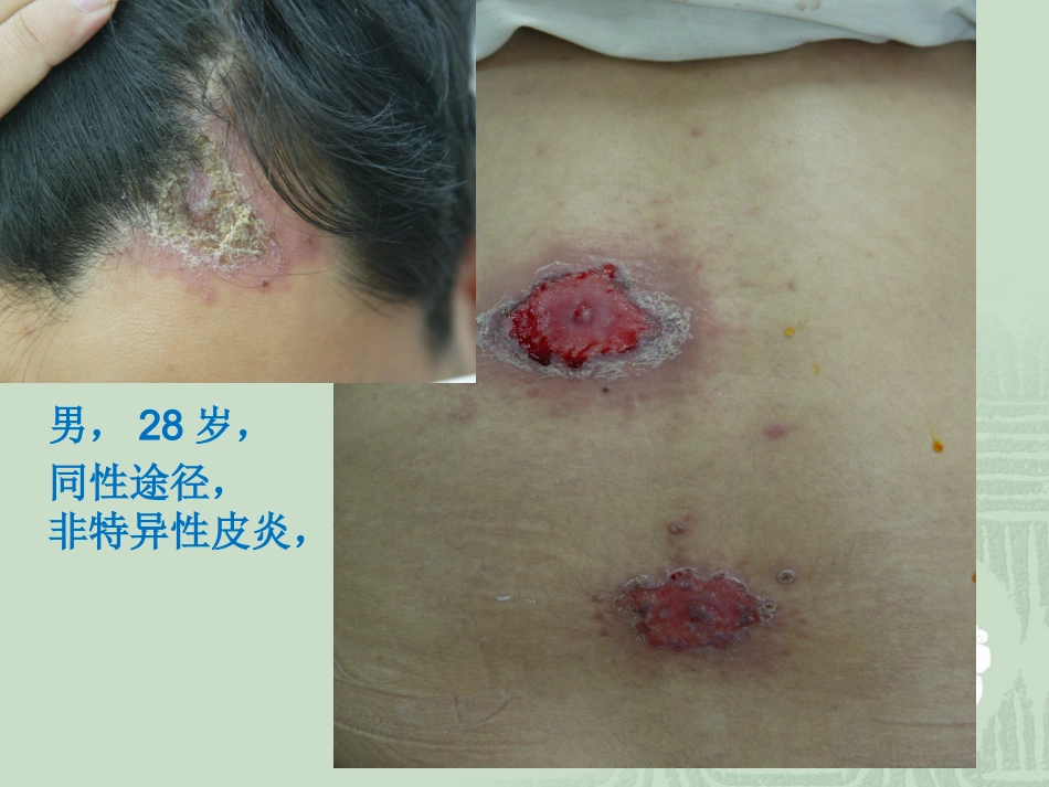 艾滋病_第7页