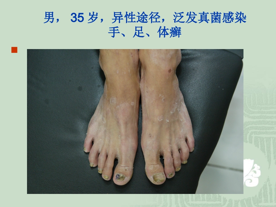 艾滋病_第8页