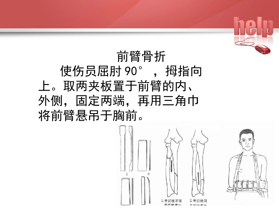常见骨折的现场急救固定_第10页