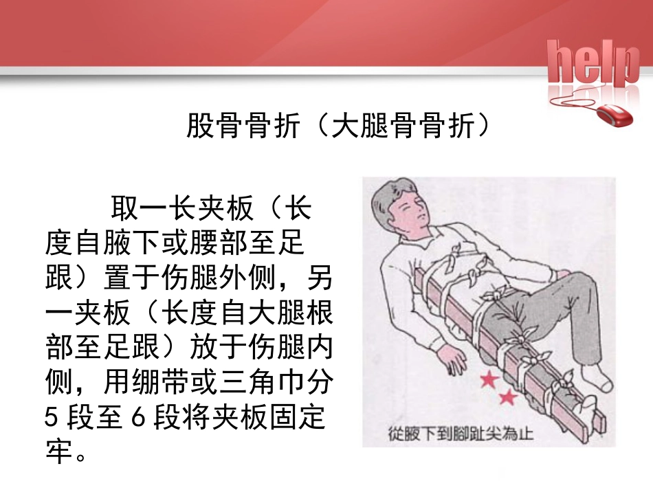 常见骨折的现场急救固定_第11页