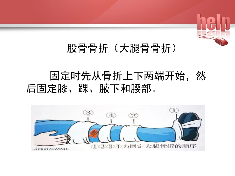 常见骨折的现场急救固定_第12页