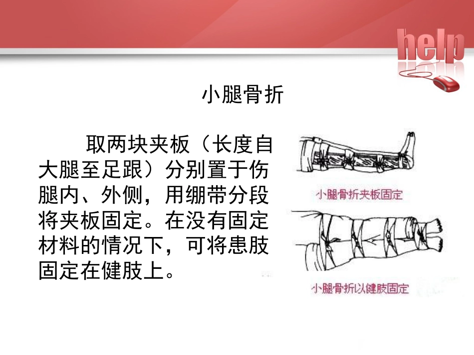 常见骨折的现场急救固定_第13页