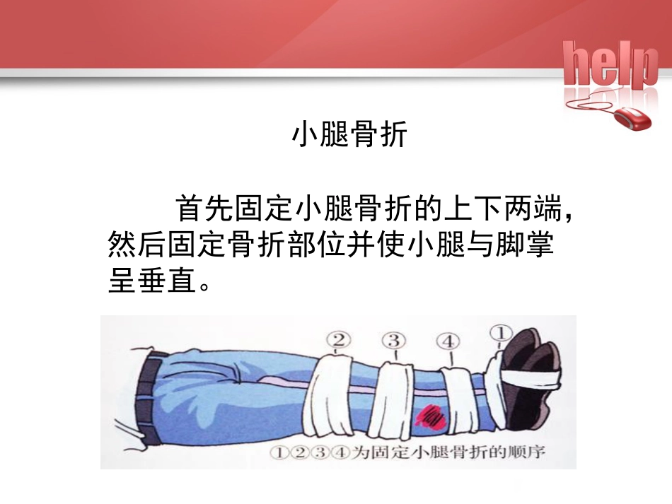 常见骨折的现场急救固定_第14页