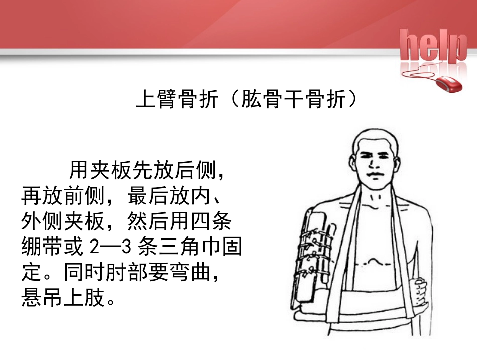 常见骨折的现场急救固定_第8页