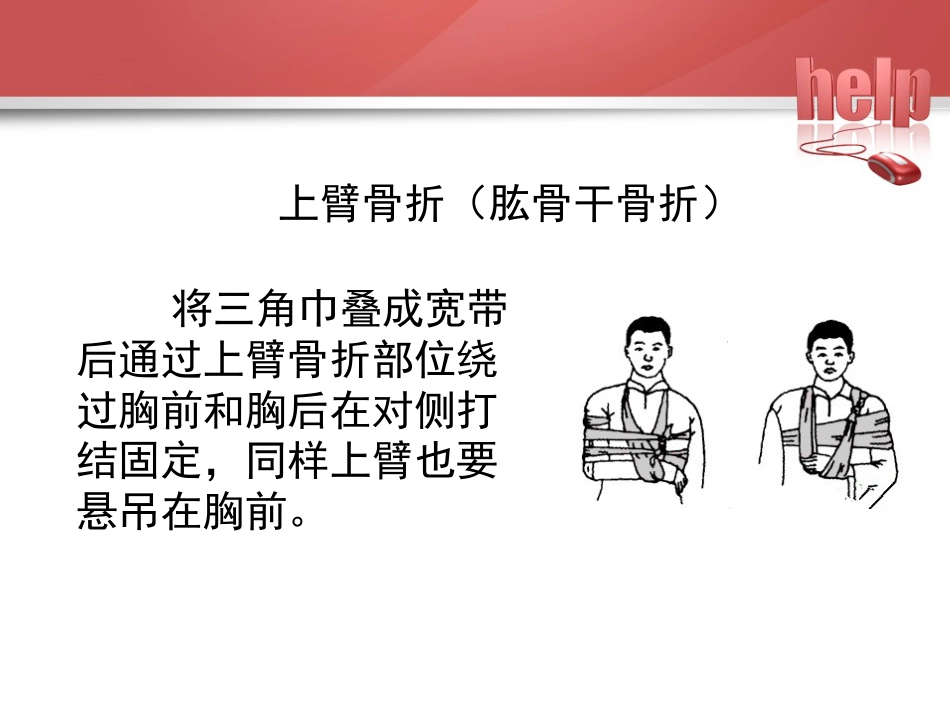 常见骨折的现场急救固定_第9页
