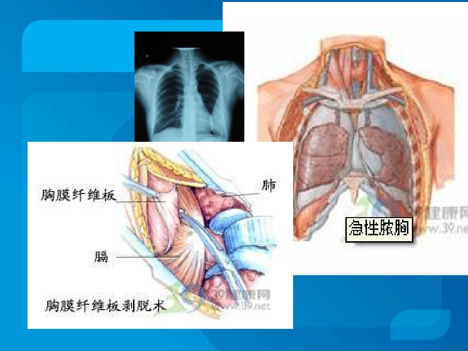 传染科-脓胸_第7页