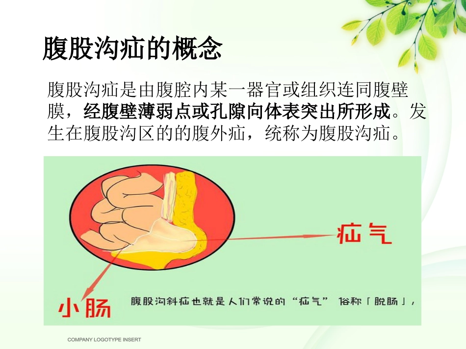 腹股沟斜疝健康宣教_第2页