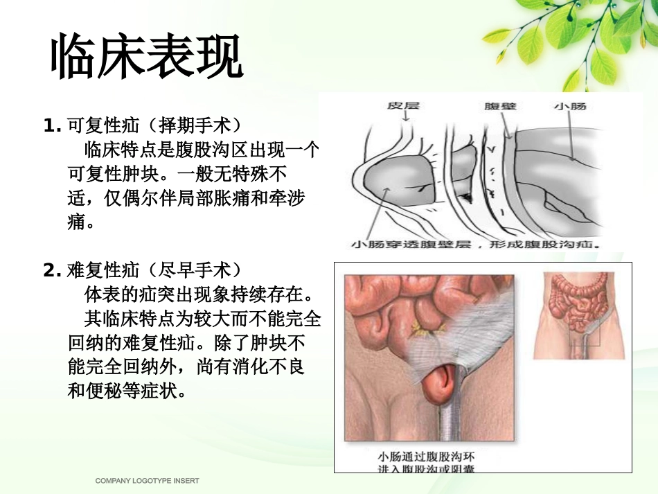 腹股沟斜疝健康宣教_第4页