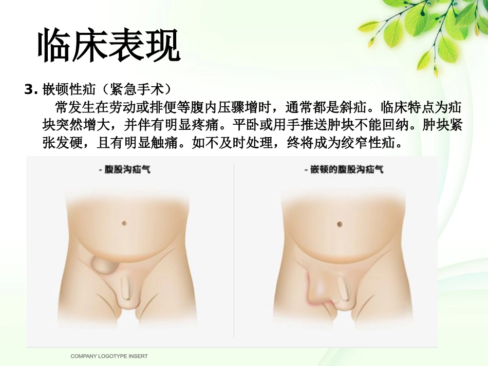 腹股沟斜疝健康宣教_第5页