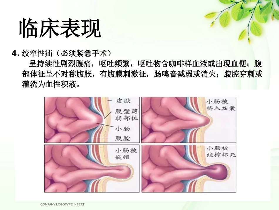腹股沟斜疝健康宣教_第6页