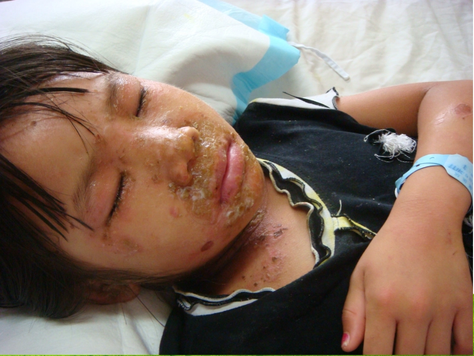 带状疱疹患者的护理及健康宣教_第14页