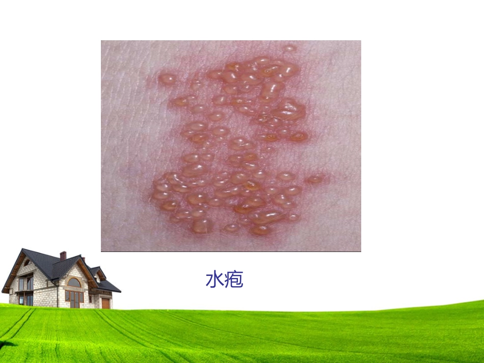 带状疱疹患者的护理及健康宣教_第3页