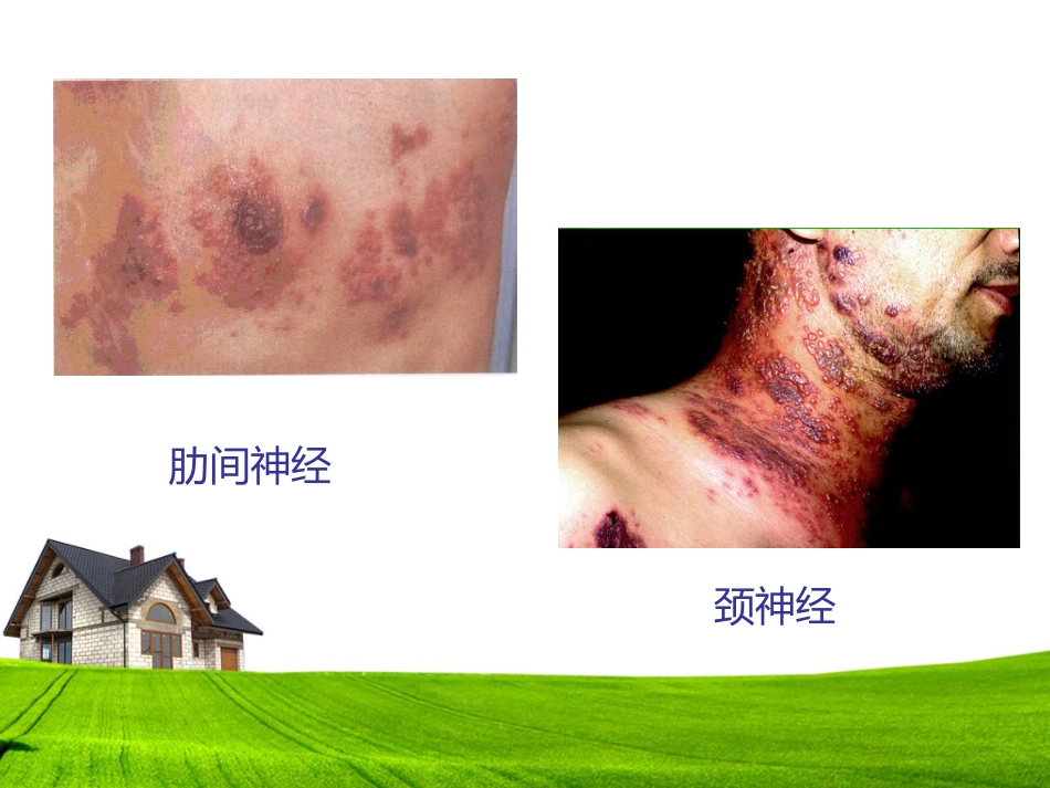 带状疱疹患者的护理及健康宣教_第6页