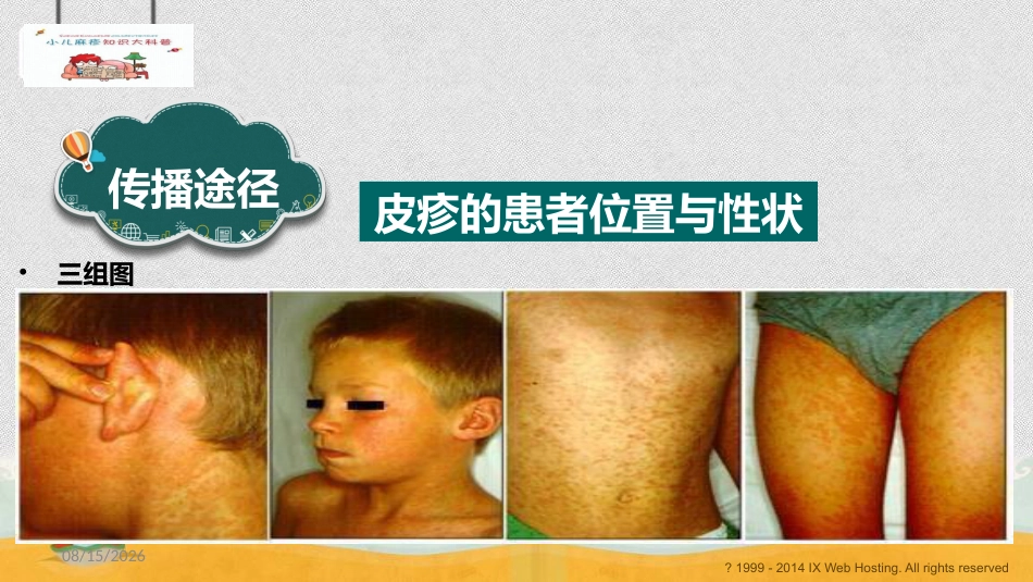 小儿麻疹科普_第7页