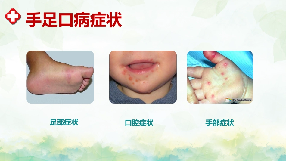 手足口病预防宣传教育PPT_第6页