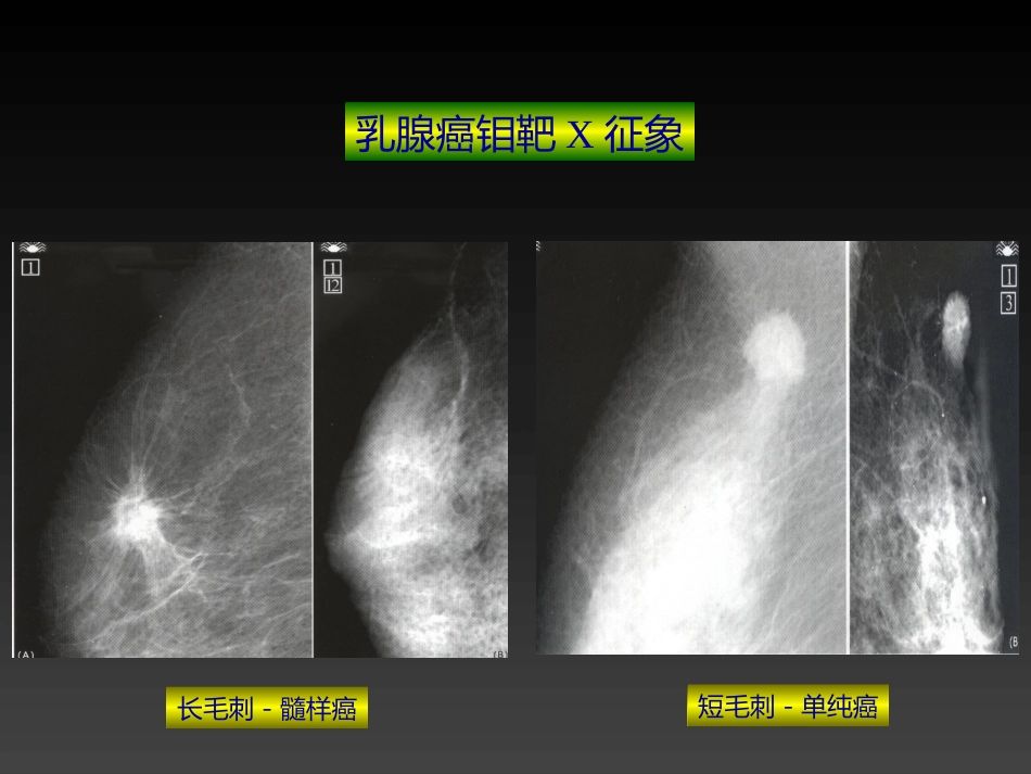 妇产科-乳房疾病_第13页