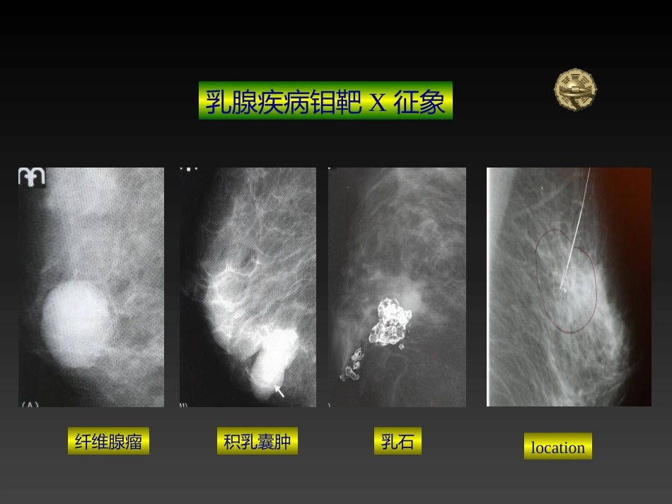 妇产科-乳房疾病_第14页