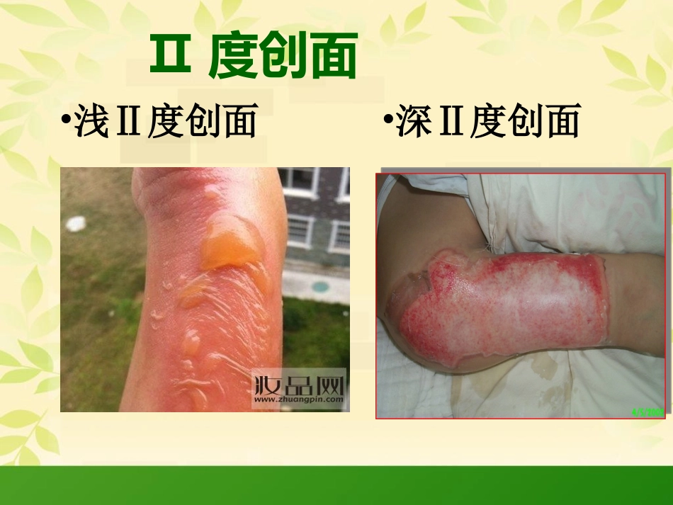 烧伤科普知识_第11页