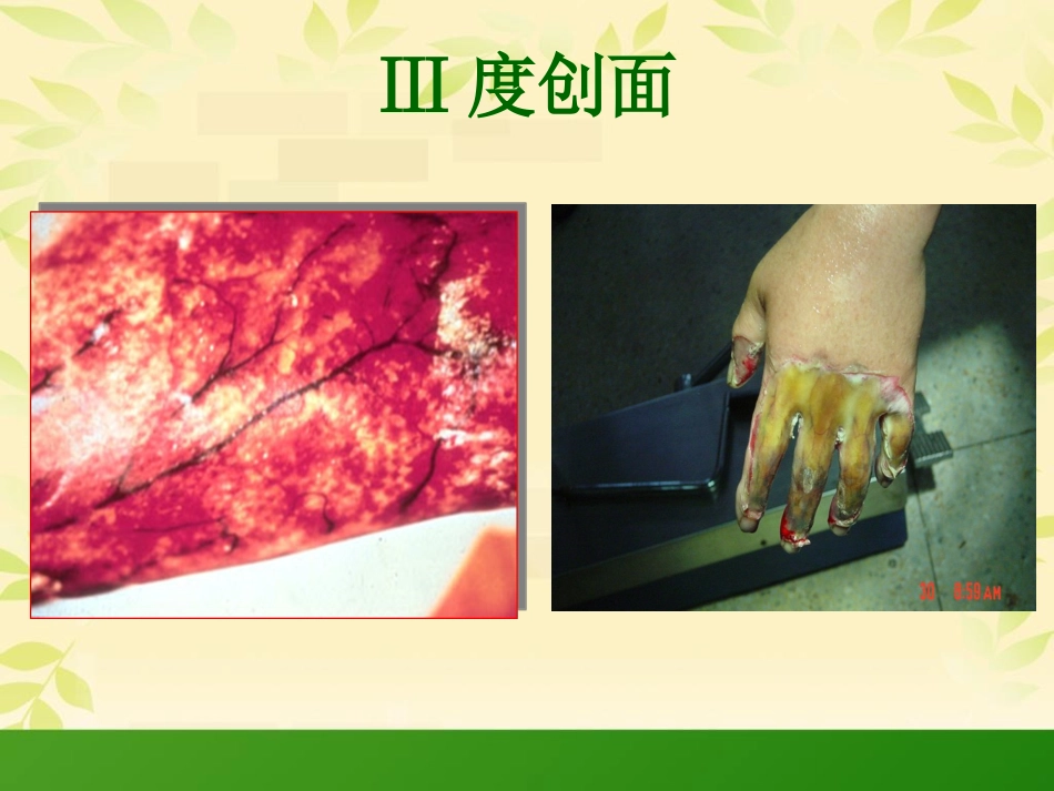 烧伤科普知识_第12页