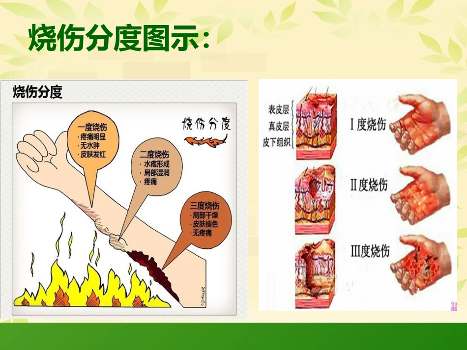烧伤科普知识_第9页