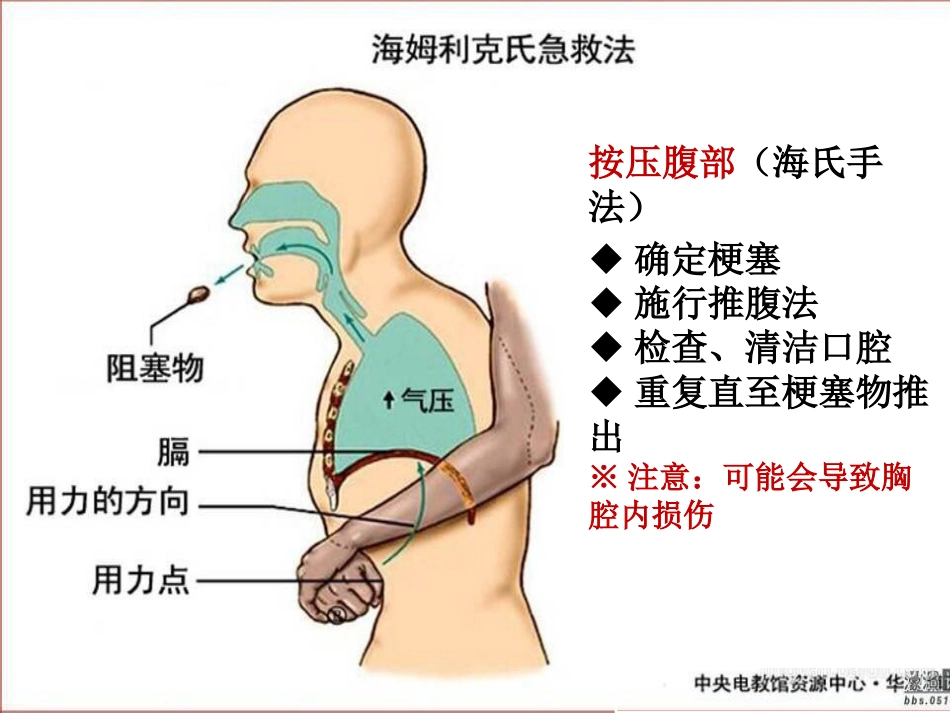 海姆立克急救法_第13页