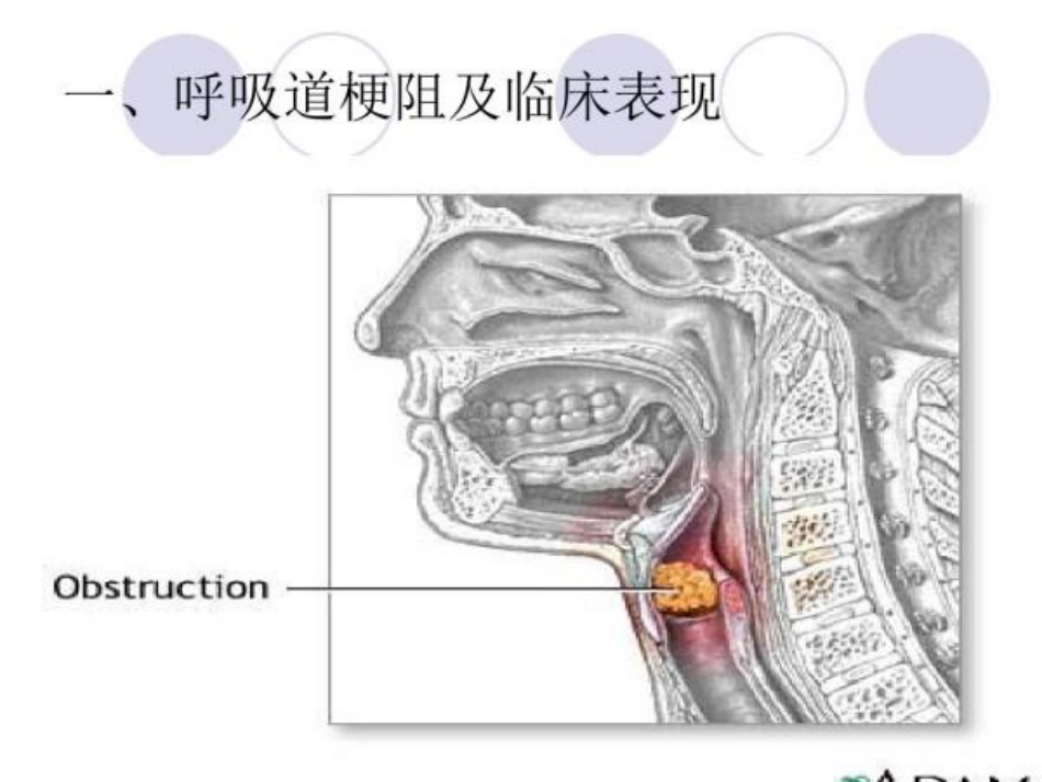 海姆立克急救法_第3页