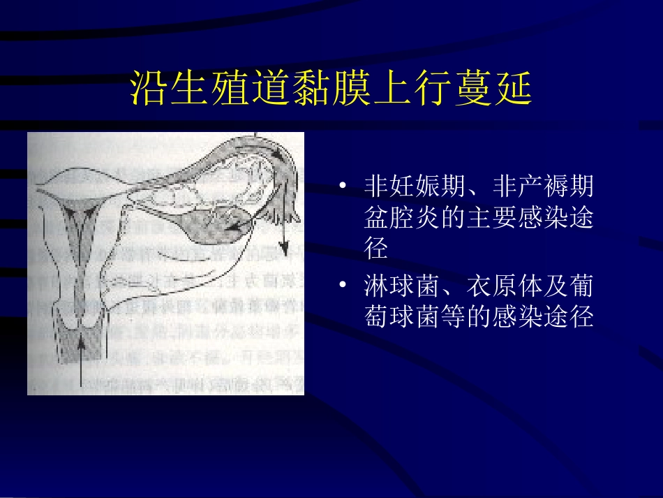 妇产科-盆腔炎_第12页