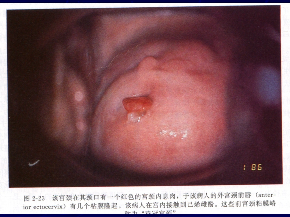 妇产科-盆腔炎宫颈炎_第11页
