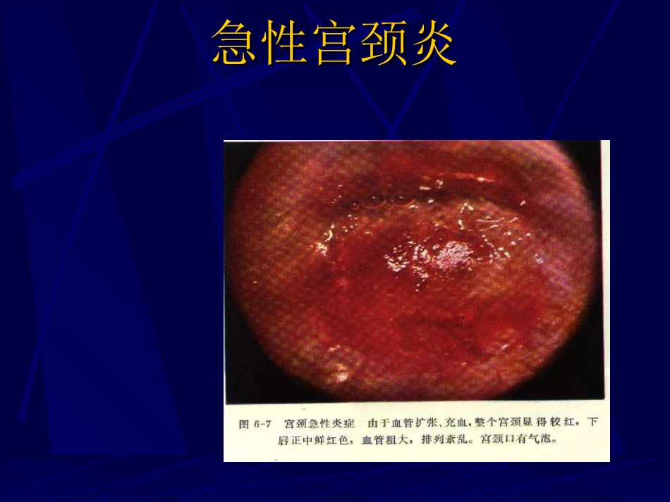 妇产科-盆腔炎宫颈炎_第4页