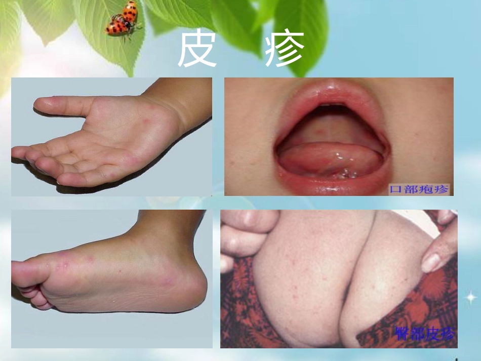 让你的孩子远离手足口病 (2)_第12页